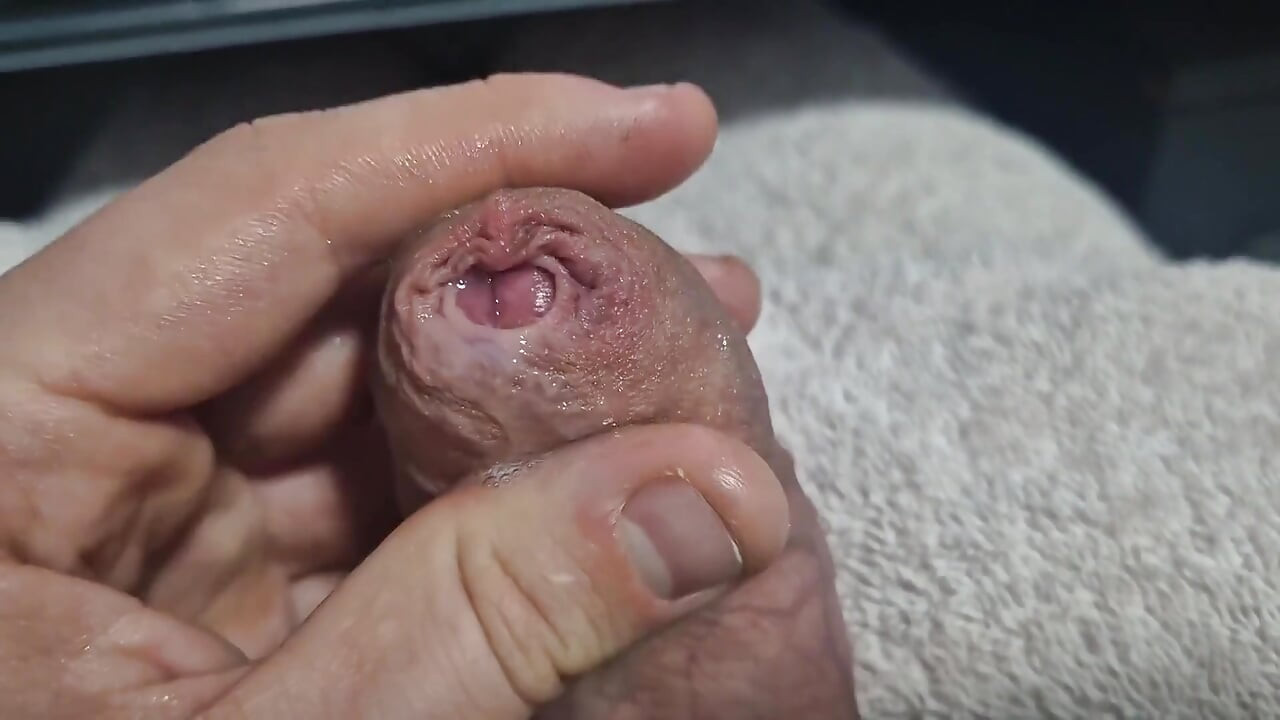 Bina khatna tng phimosis lnd chamari phaila kloj ap