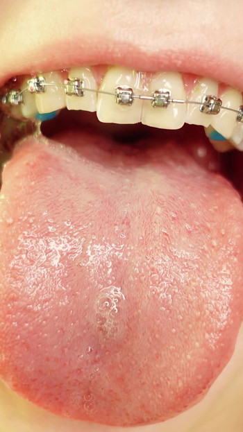 Powerful moment from "braces mouth tour video - vore fetish"