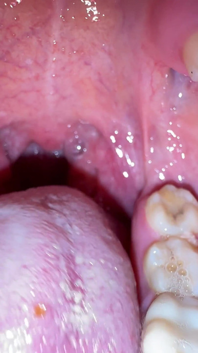 Mouth Secrets: Thick White Coating on My Tongue