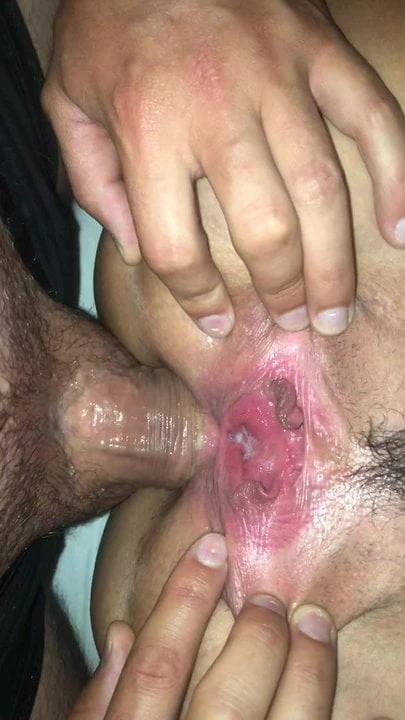 Anal spreading