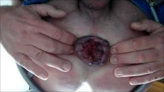 指マン肛門極端なローズバッドギャプアナル拡張