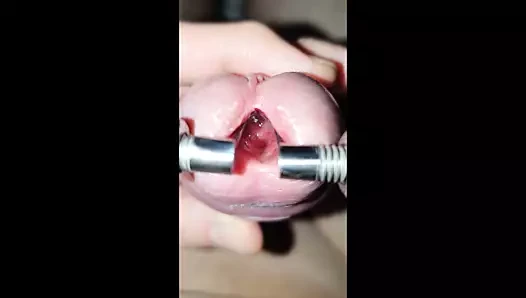 Genç üretra maksimuma uzanır, içeriye bakar ve içeride 10 mm dilatör