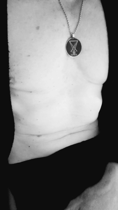 Acidente vascular cerebral rápido
