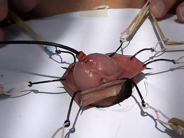 fishhooks in foreskin