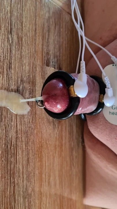 E- estimulación