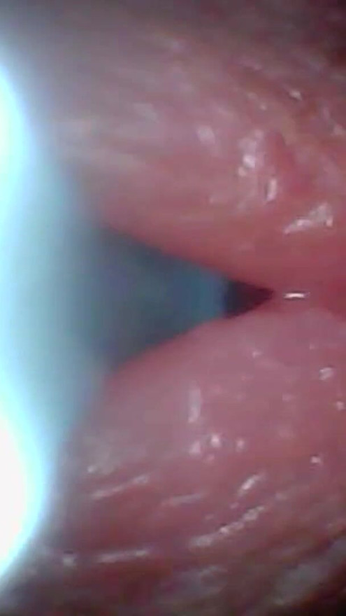 Endoscope camera captures moment of male ejaculation | Clip 1
