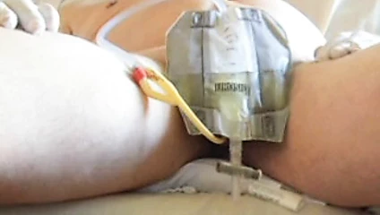 Exploding Bladder porn video – Inserting an 18fr foley catheter into my bladder