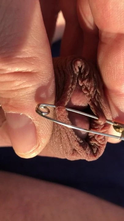 Safety pin in foreskin