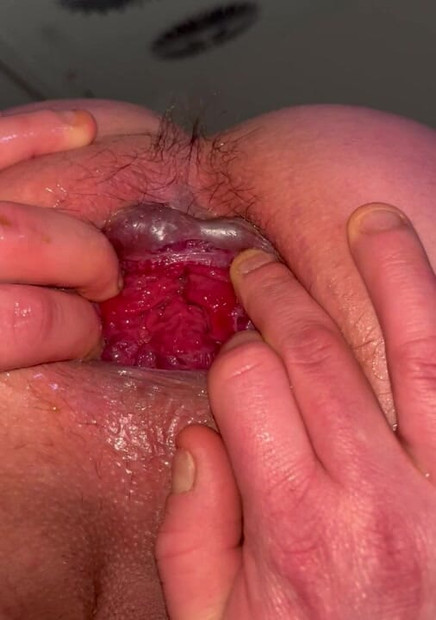 Anal Gape Open Ass  Prolapse