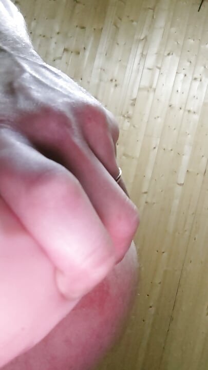 Anal Prolapse,Anal