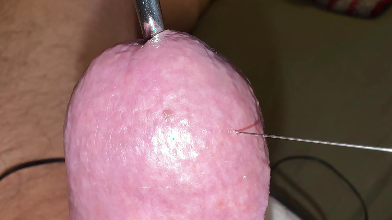 Acupuncture - Orgasm!