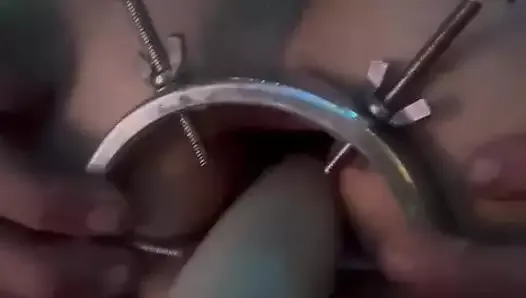金属肛门扩张器