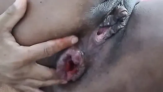 Memulai prolapsku