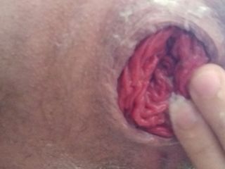 Close -up van zelfvuistneuken met anale verzakking