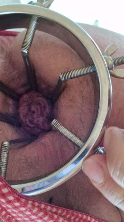 Anal dilation