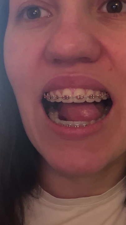 혀로 교정기를 핥기