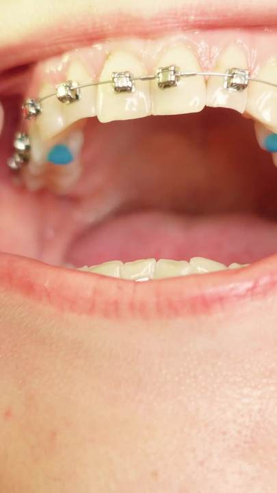 Iconic moment from "eating in braces - vore and food fetish - close up video"