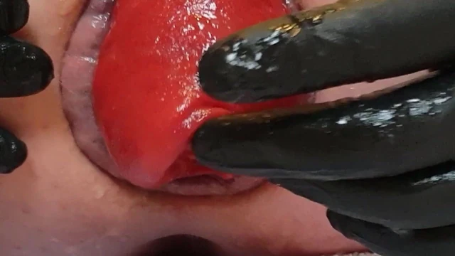 More prolapse