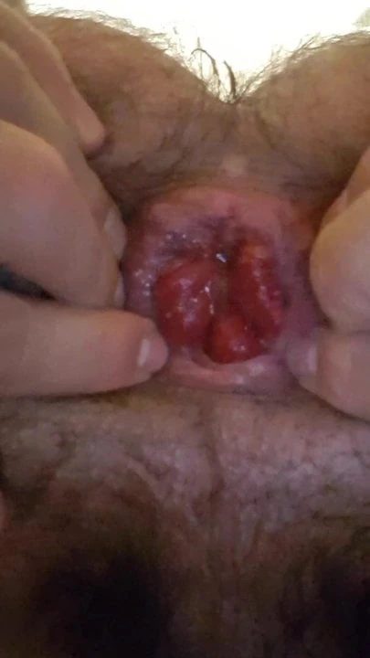 anal prolapse