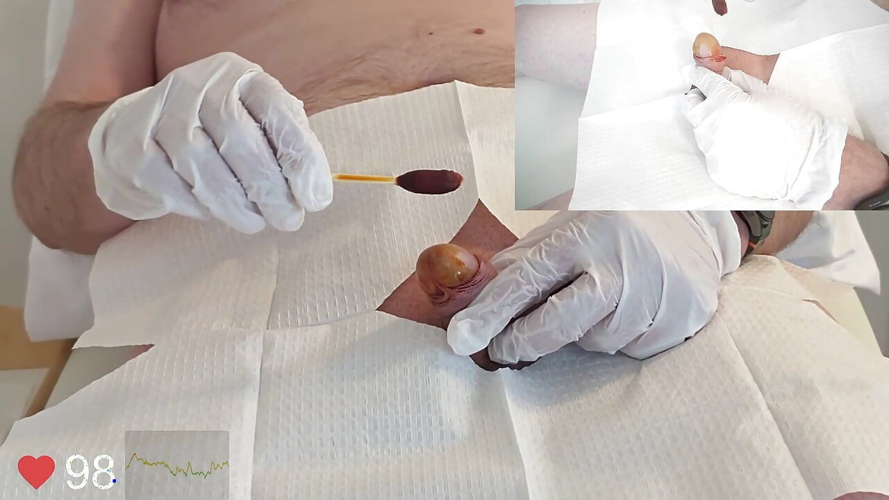 Close-Up insertion of a 16 French foley catheter