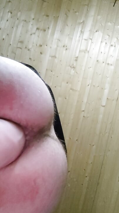 Anal Prolapse,Anal