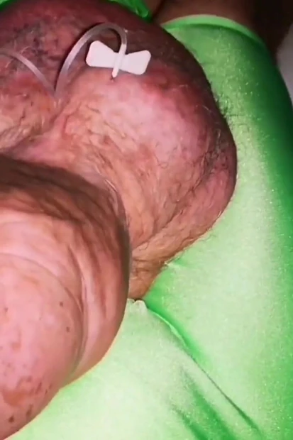 Another Extreme Filling up with Glucose