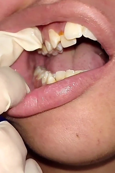 Trying to Use Dental Floss (close-up)