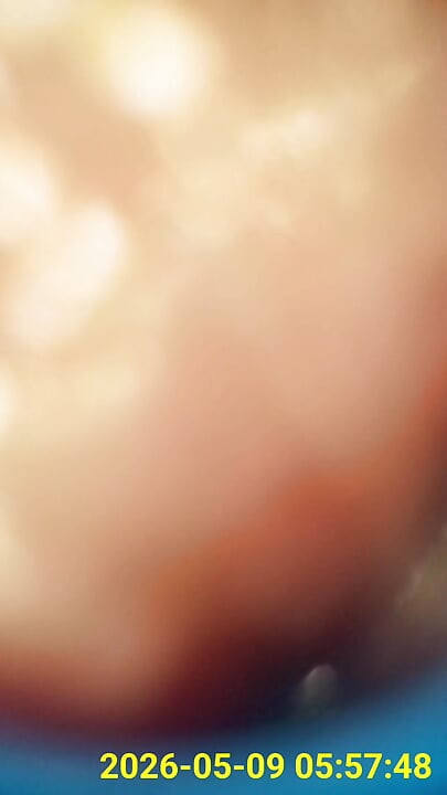 Close up of buttplug & HD Endoscope insertion