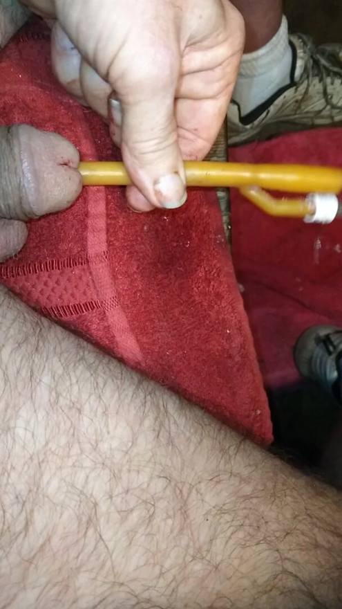 30 Fr catheter