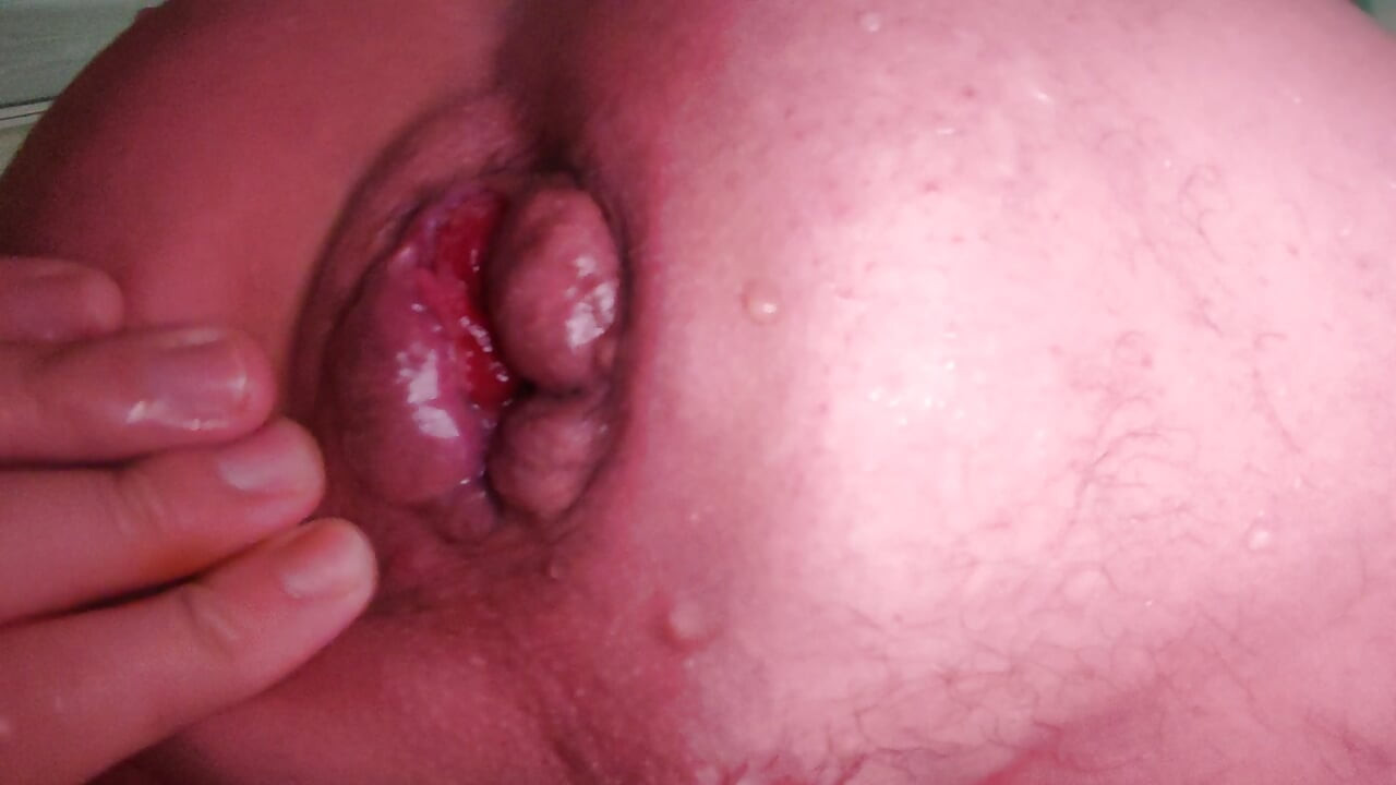 Anal fisting