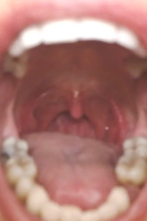 목구멍과 입 침 뱉기 끈 Uvula 편도선 Uvula