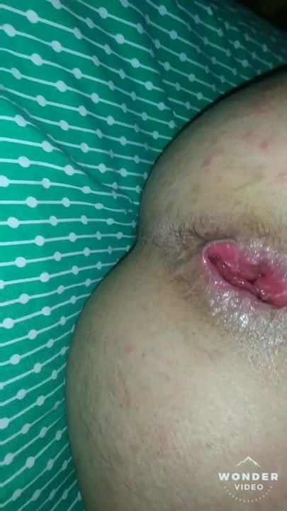 Fast prolapse my ass