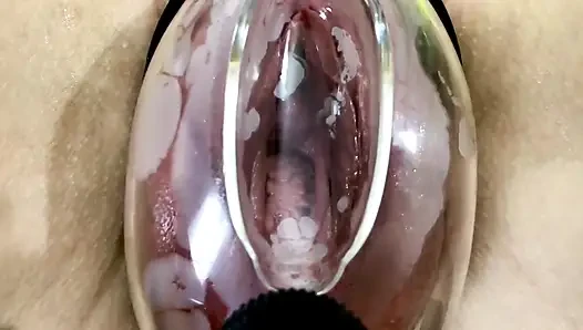 Вагинальная деформация под действием вакуумной насоса