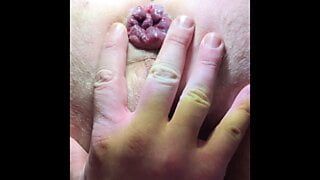 Small prolapse and anal play