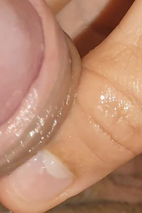 Large Cheese Accumulated in Close up of Glans