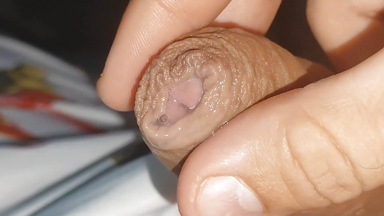 Primer Plano Curioso Del Líquido Preseminal En Fimosis Flácida.