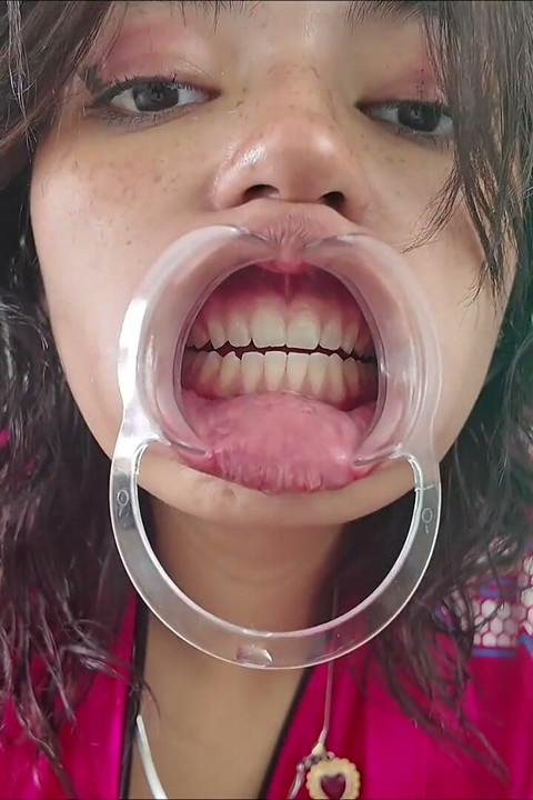 Cheeks Pulled Apart Teeth Exposed
