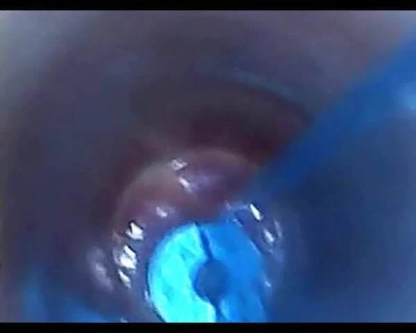 test tube cock endoscope POV urethral insertion ball rod