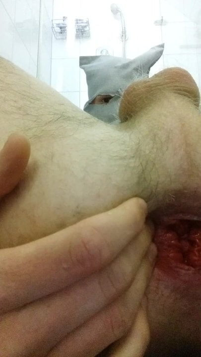 Man prolapse anal fisting