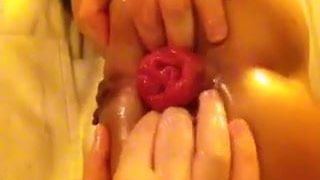Anal Fisting and Prolapse
