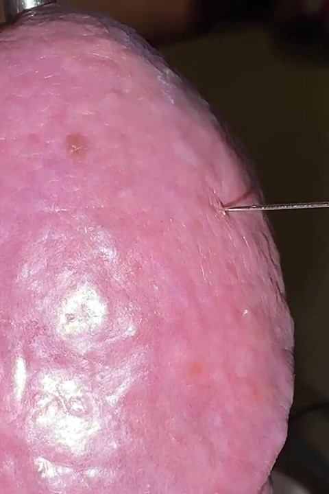 Acupuncture - Orgasm!