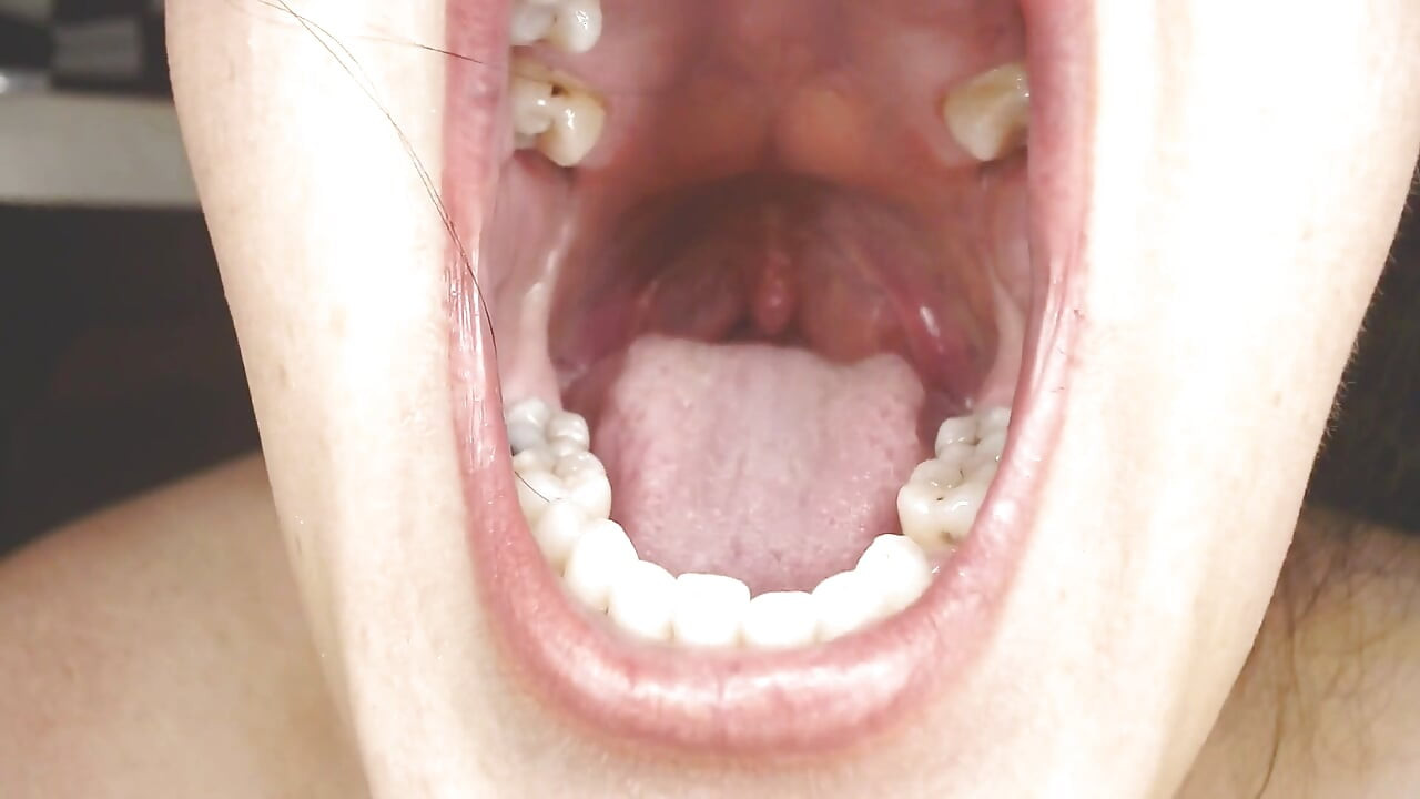 喉咙和嘴巴吐绳Uvula扁桃体Uvula
