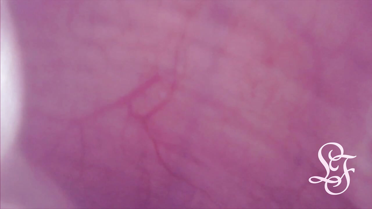 Bulge INSIDE my Bladder from Anal