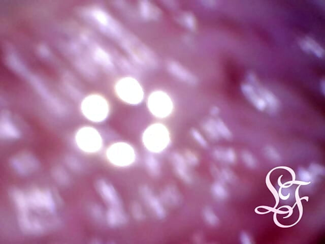 Can I fit the minicam AND a catheter inside my pee hole at the same time?