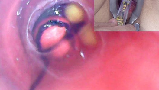 Dojrzała kobieta, kamera endoskopowa peehole w pęcherzu z kulkami