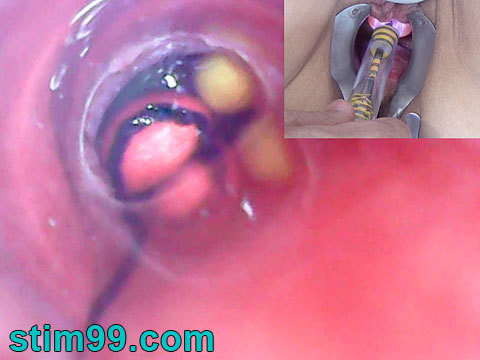 Mature Woman, Peehole Endoscope Camera in Bladder with Balls