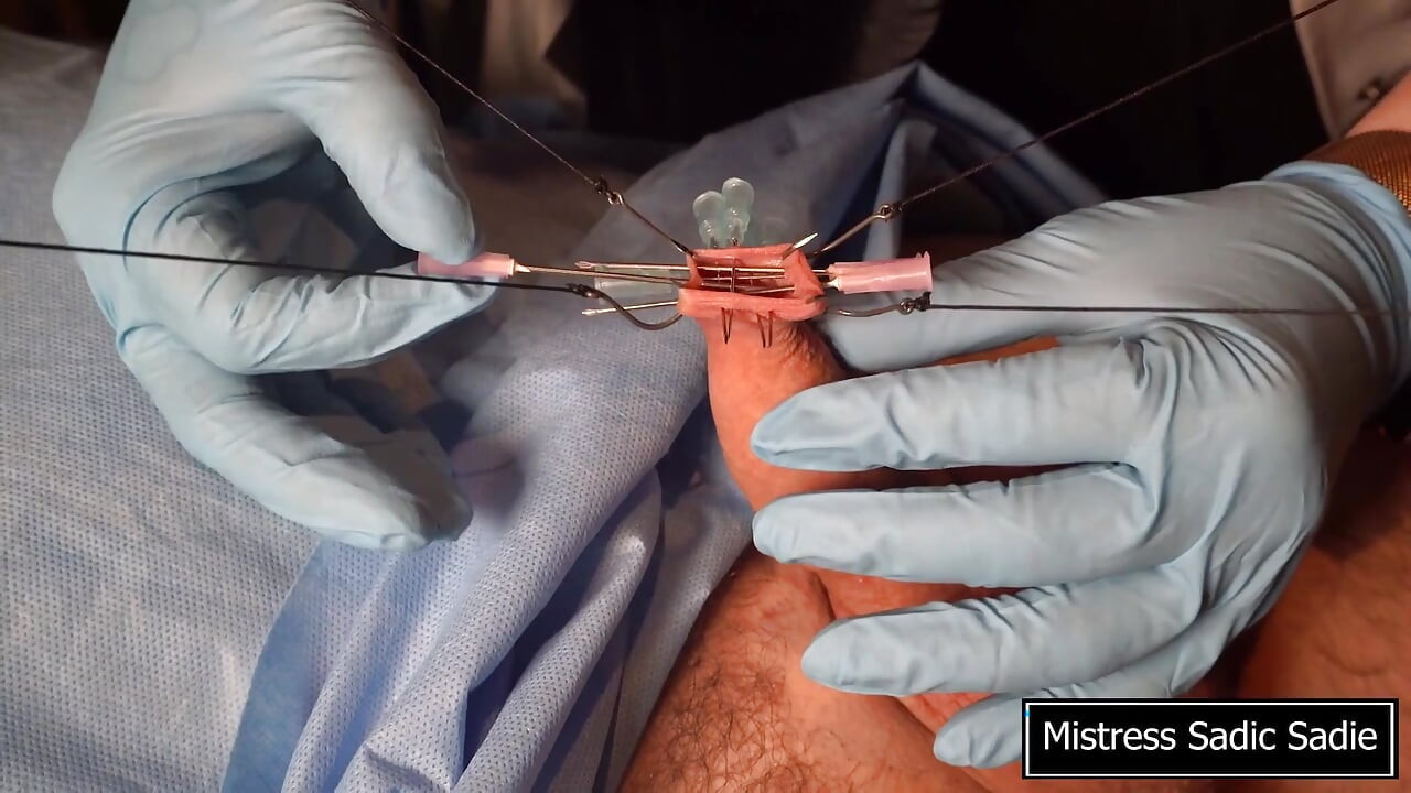 Needle CBT at It's Finest.