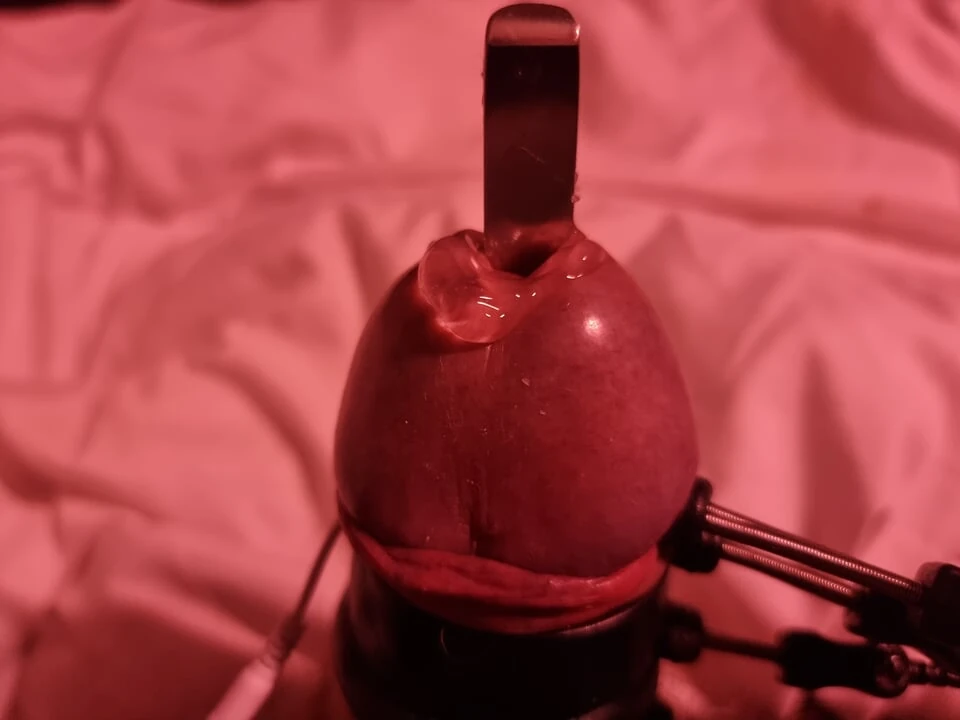 Sonde in der Harnröhre und Elektrode am Et312