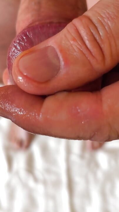 Foreskin back