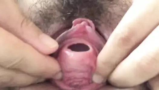 Anal stick insertion into the urethra